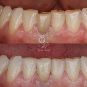 veneers by Dr.Anas Ali